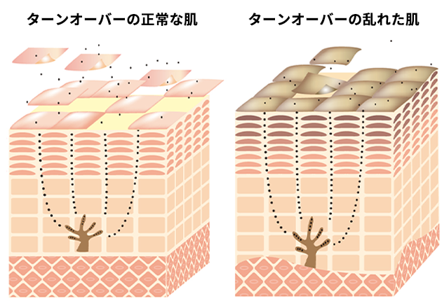 ターンオーバー